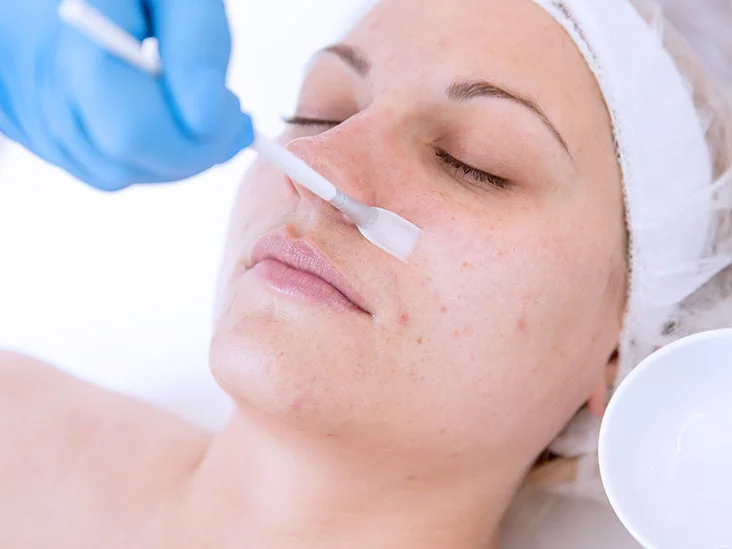 Benefits of chemical peel for anti aging
